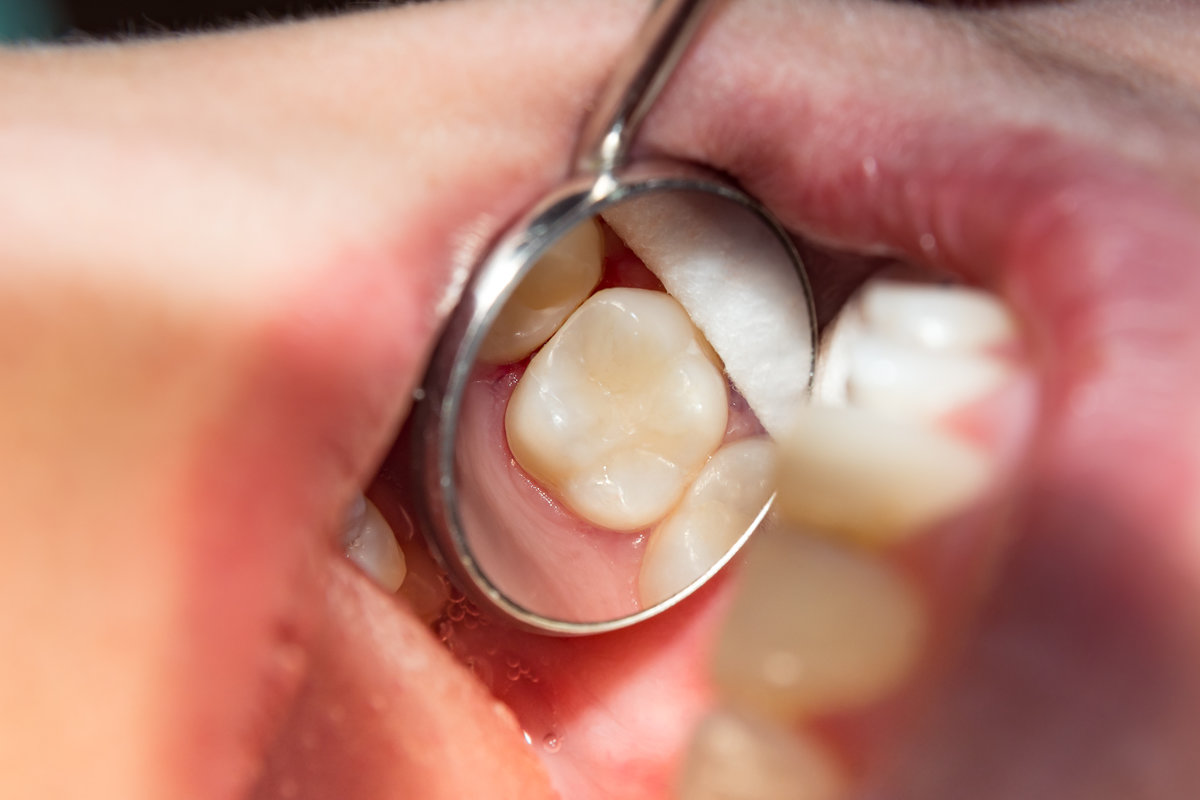 adobestock 187063042 - Kabani Dental